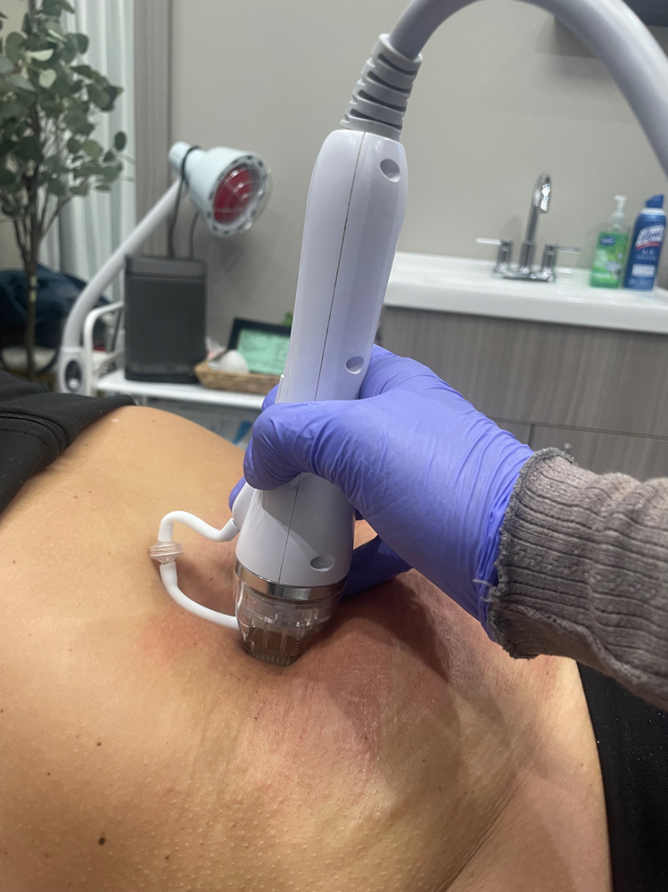 Fractional Radiofrequency Face,Body
