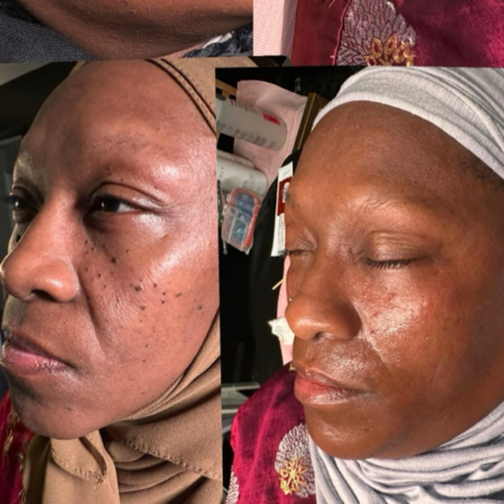DPN/Skin Tag Removal at She Esthetics LLC in Columbus, GA