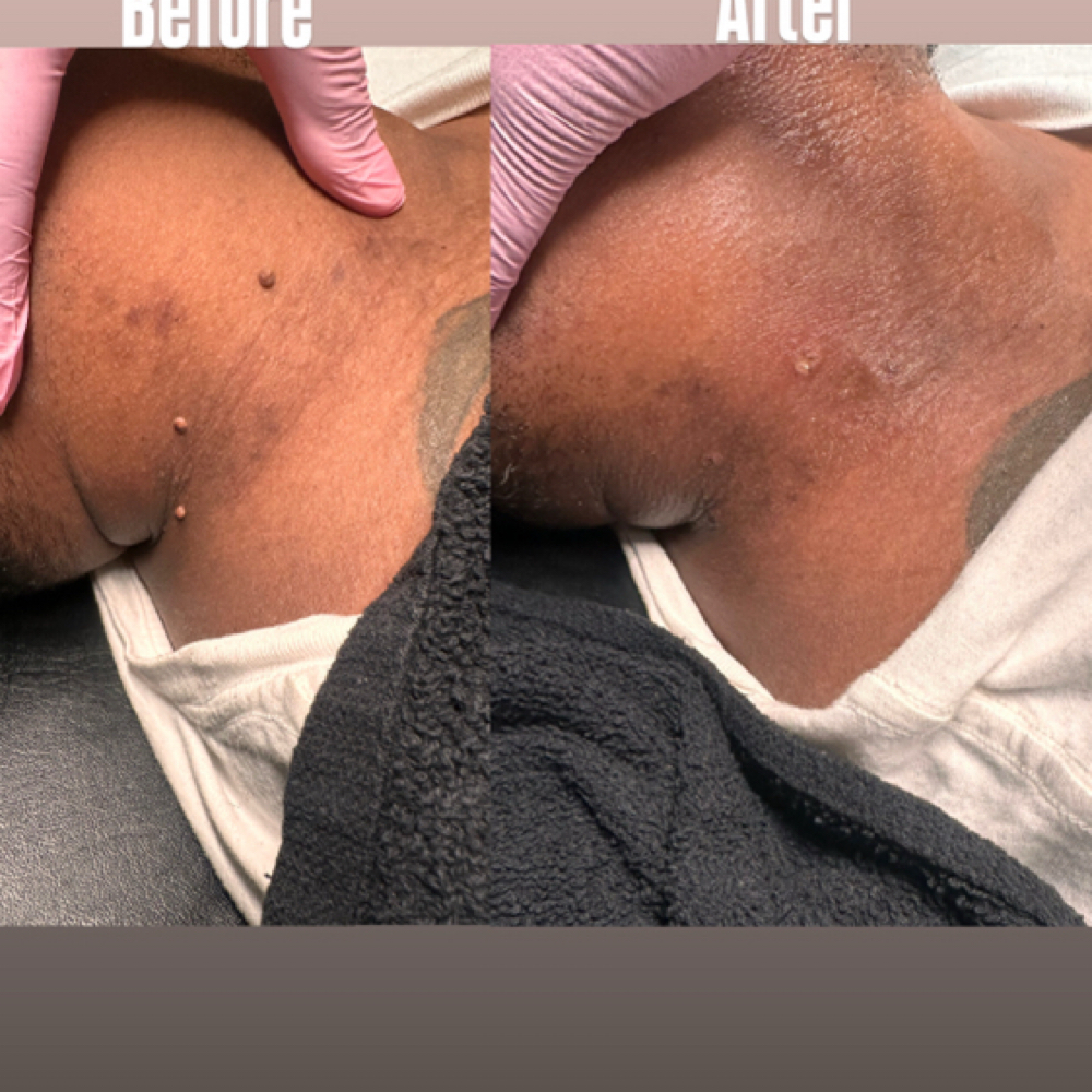DPN/Skin Tag Removal at She Esthetics LLC in Columbus, GA