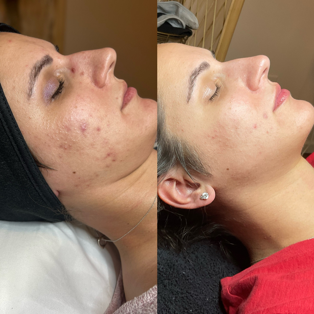 The Perfect Derma Peel