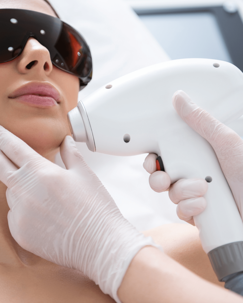 AcuPulse Laser Peel