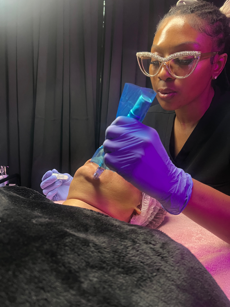 Microneedling