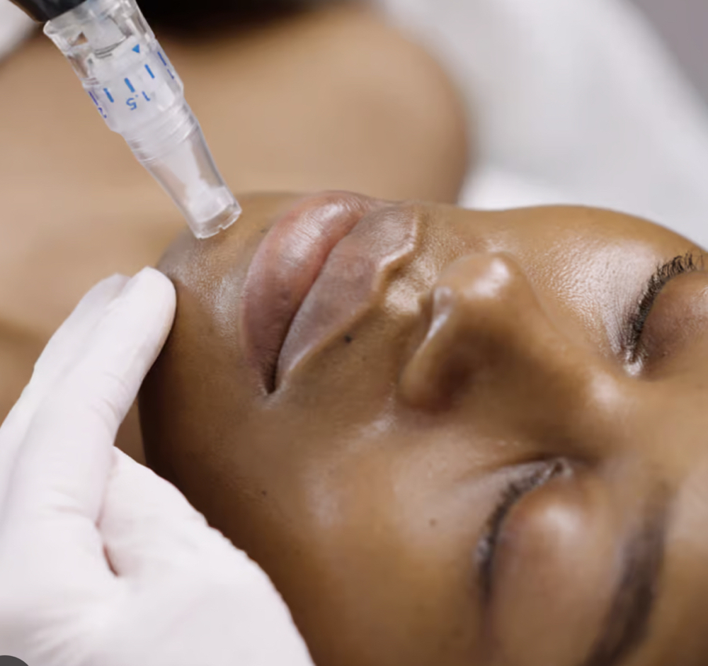 Microneedling