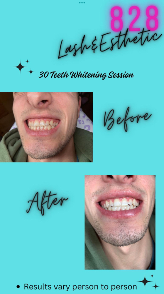 30 Min Teeth Whitening Session