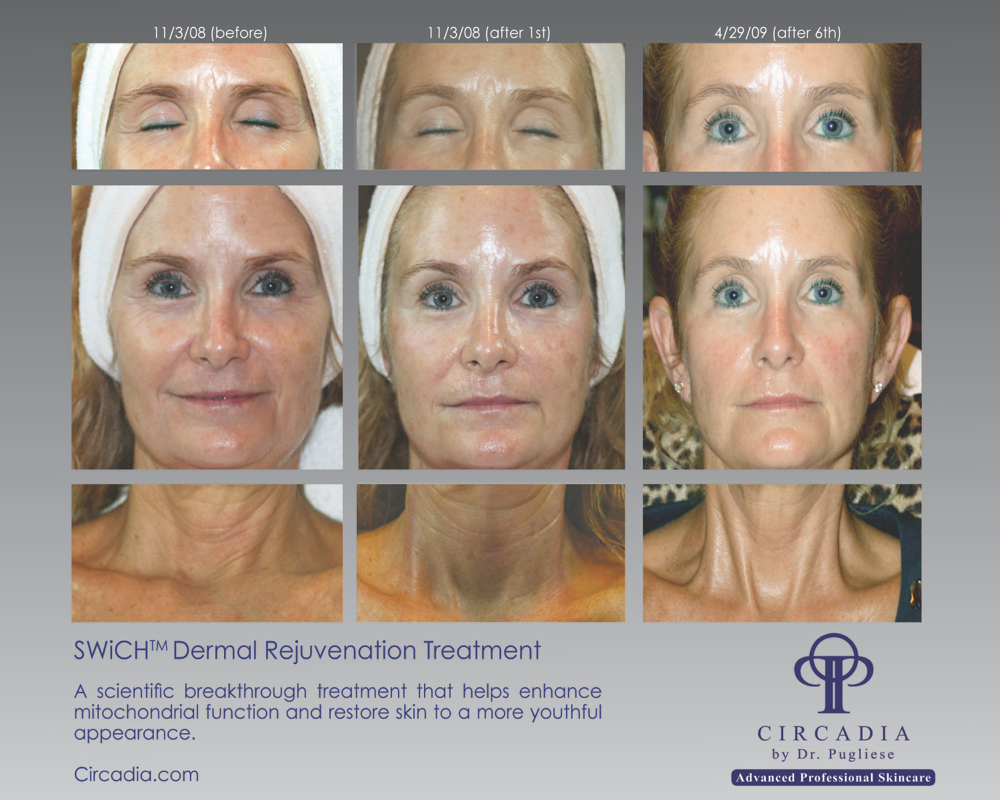 SWiCH Dermal Rejuvenation (60min)