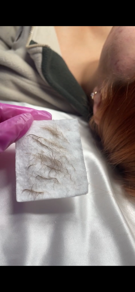 Dermaplane Facial