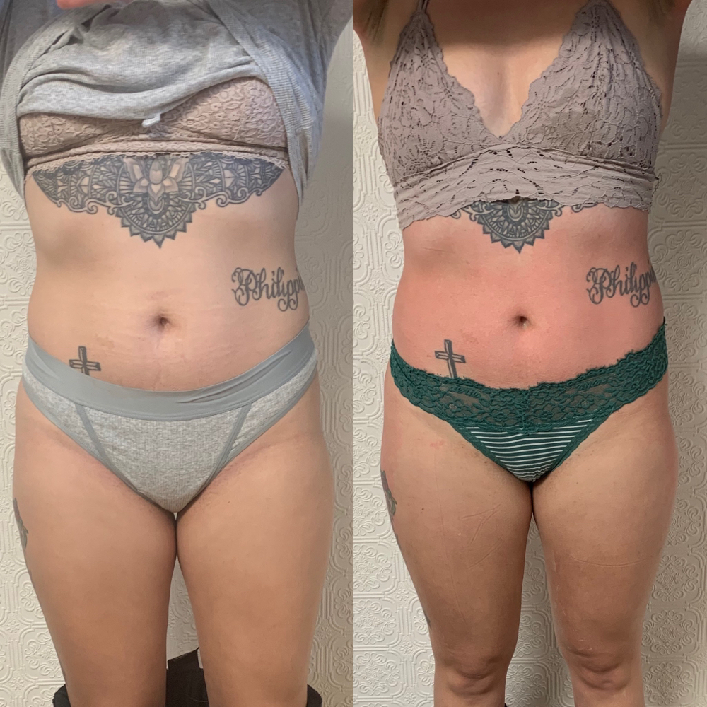 Full Body Sculpt Ice