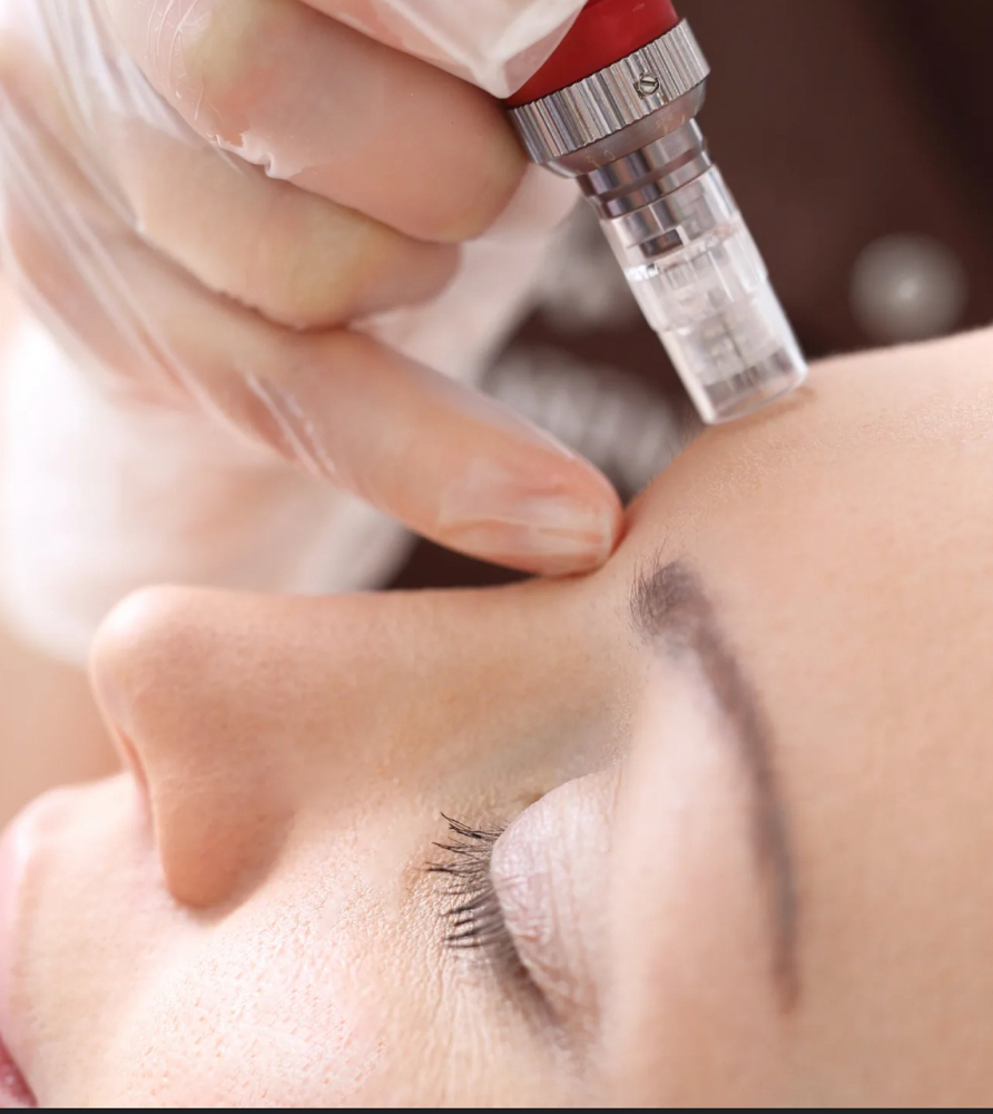 Microneedling