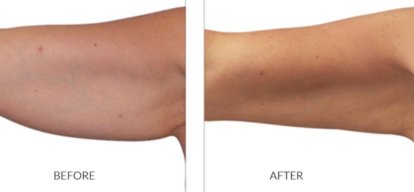 Venus Arm Treatment