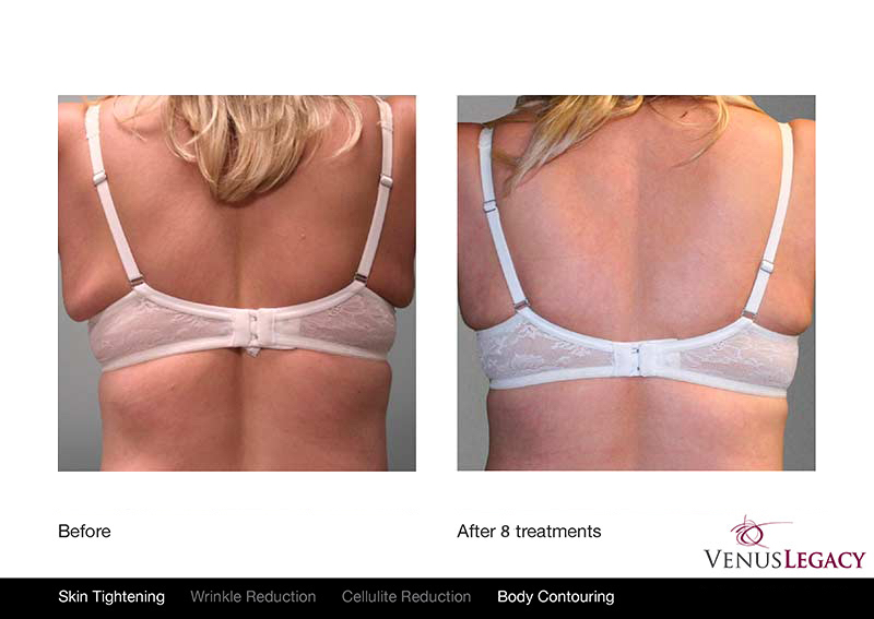 Venus Bra line Treatment