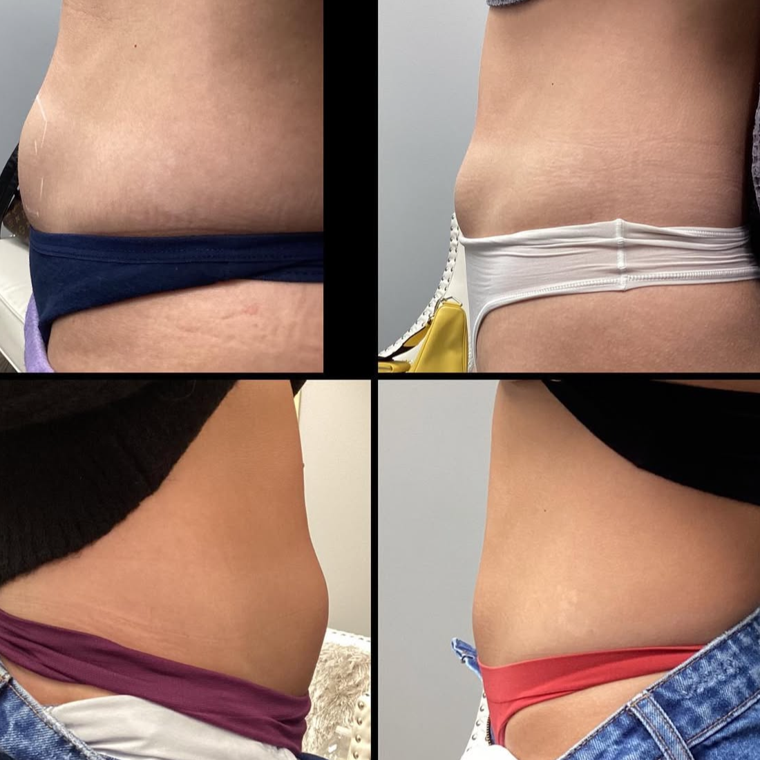 Fat Dissolver (Body PCDC) at Akki Aesthetics in Williston Park, NY