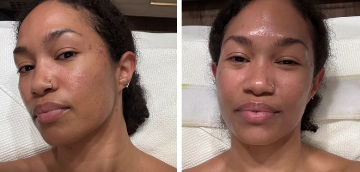 Hydra Facial