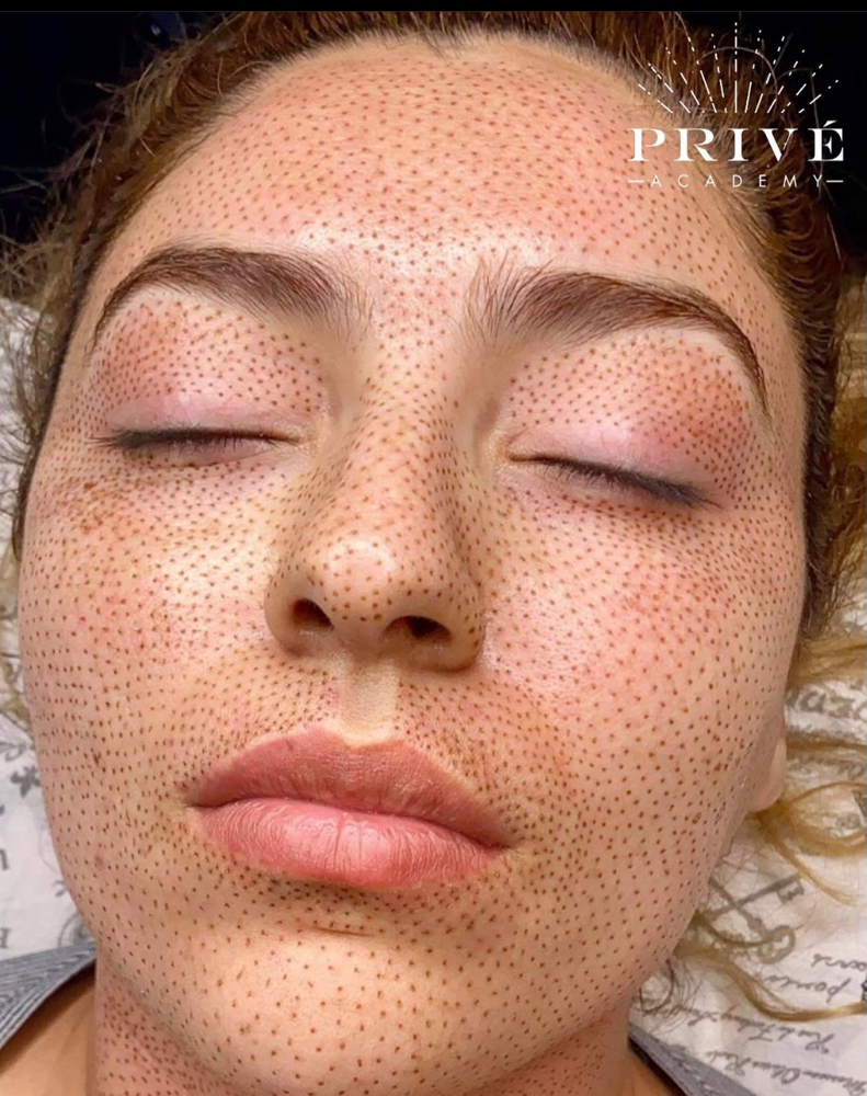 Full Face Coverage Plasma Lift