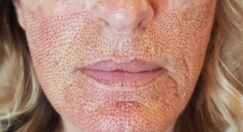 Lower 1/2 Full Coverage Plasma Lift