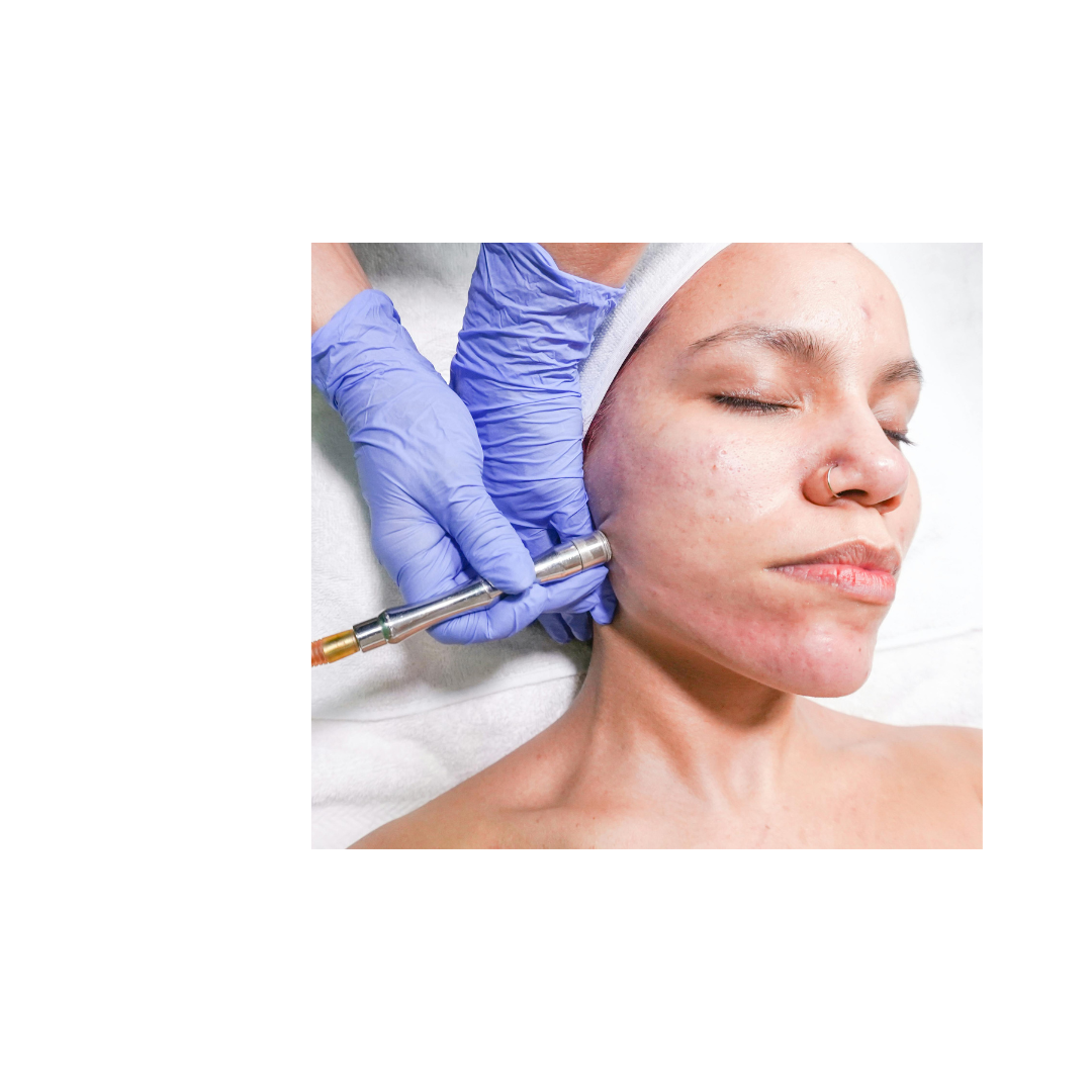 Microderm -