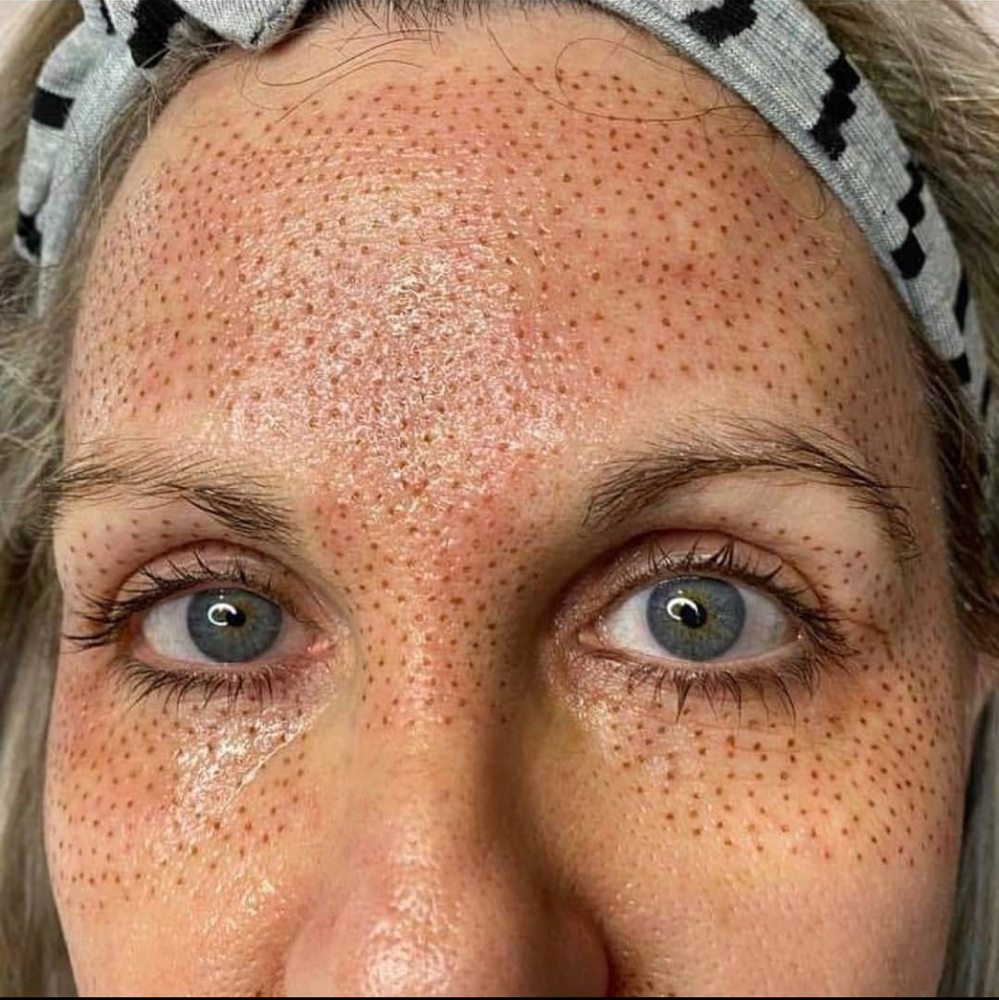 Upper 1/2 Full Coverage Plasma Lift