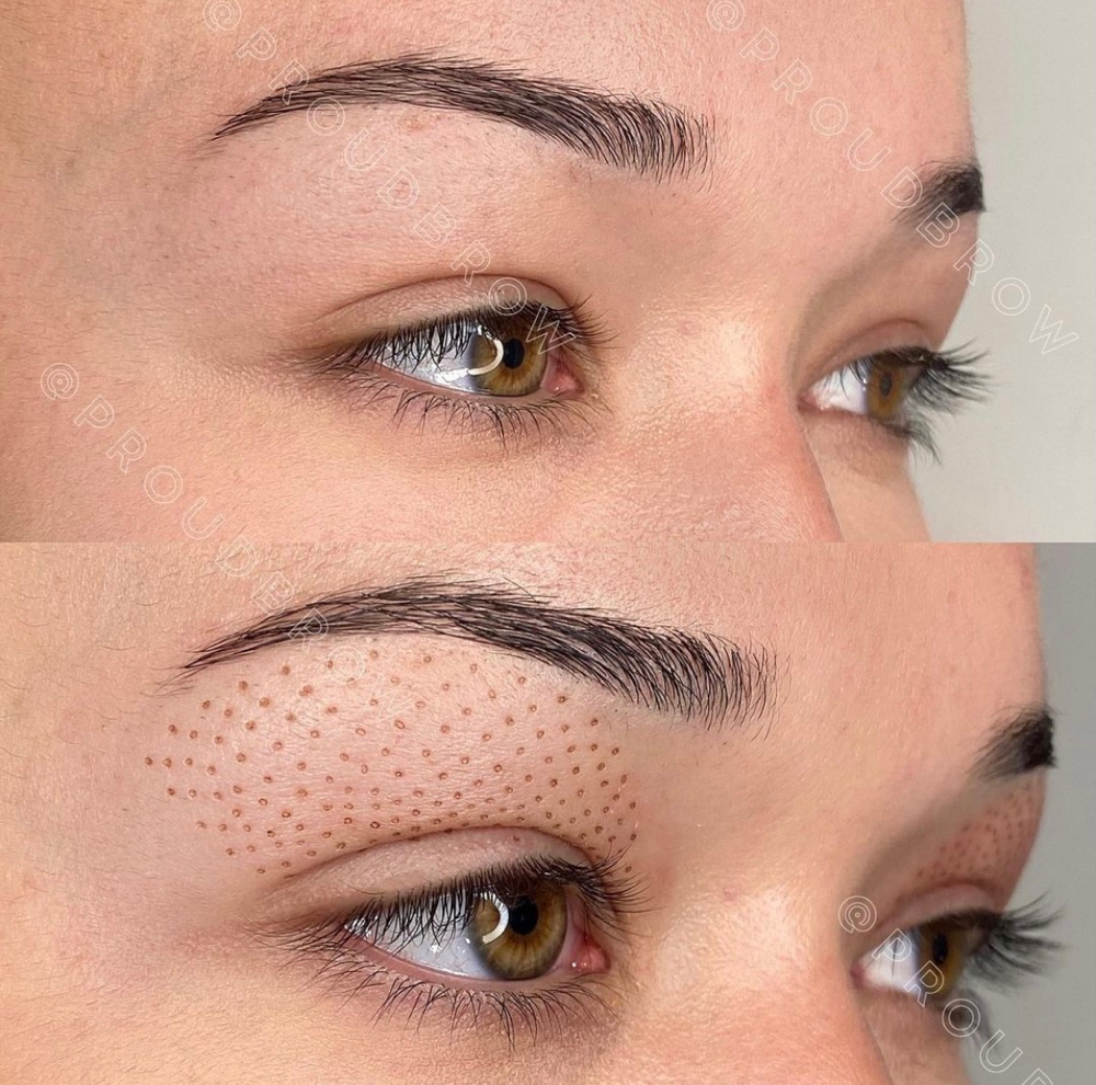 Upper Eyelid Plasma Lift