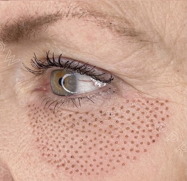 Lower Eyelid Plasma Lift