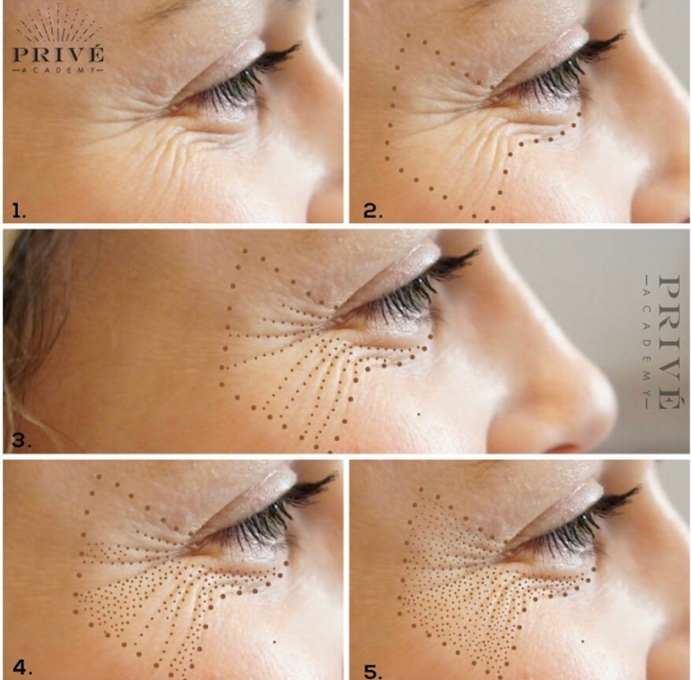 Crows Feet Plasma Lift