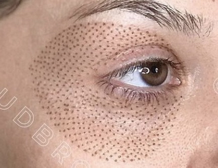 Panda Plasma Lift (Covers 3 Areas)