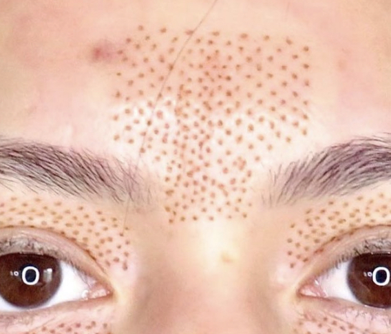 Frown Lines Plasma Lift