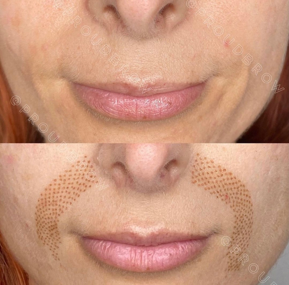 Nasolabial Fold Plasma Lift