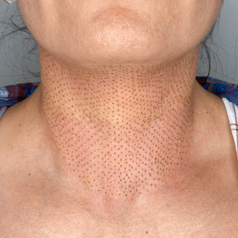 Neck Plasma Lift
