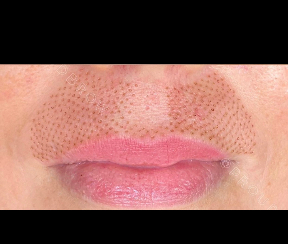 Upper Lip Plasma Lift