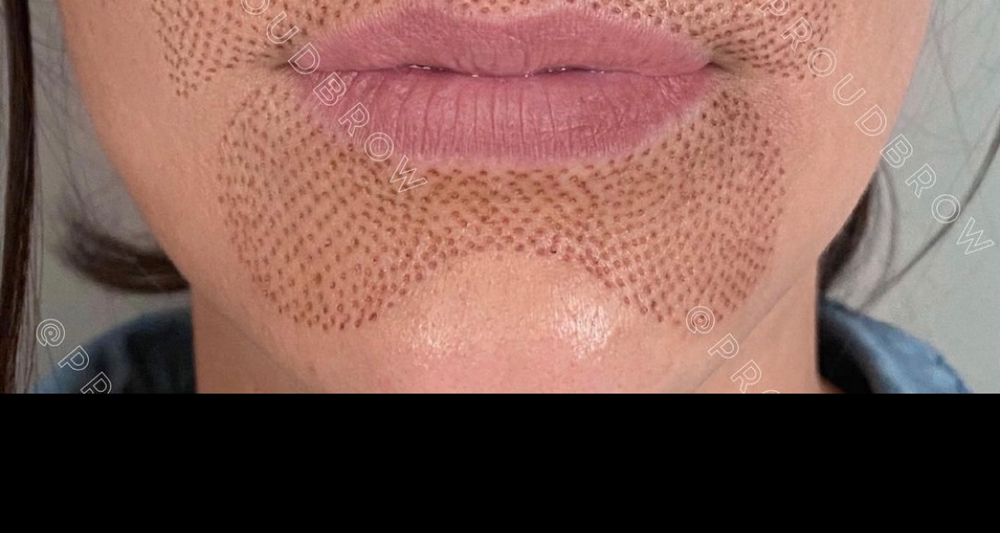 Lower Lip Plasma Lift