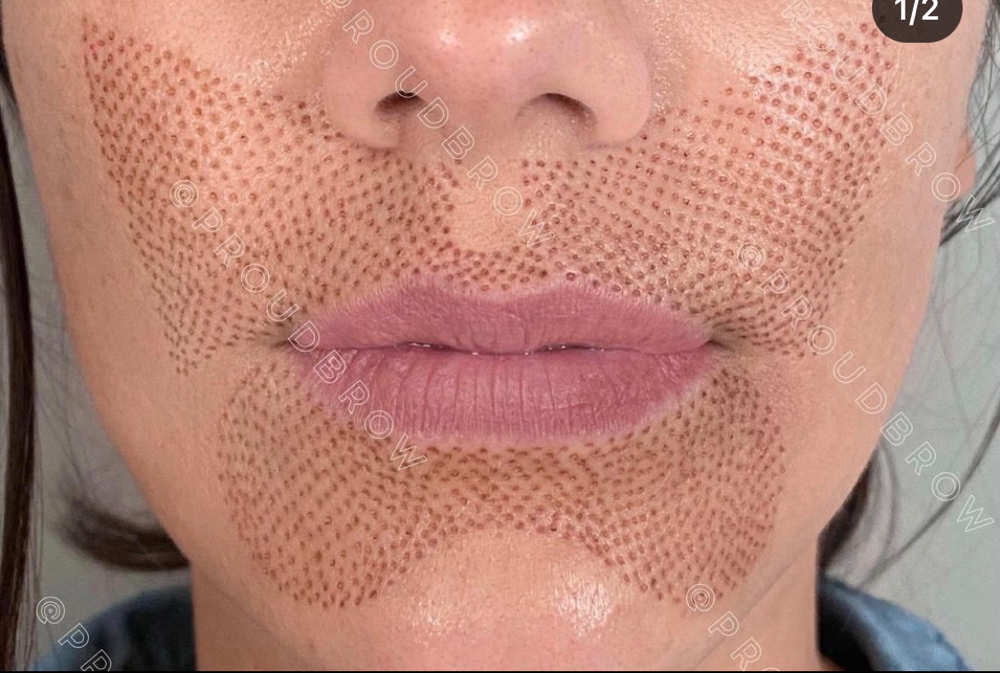 Butterfly Plasma Lift ( 3 Areas )