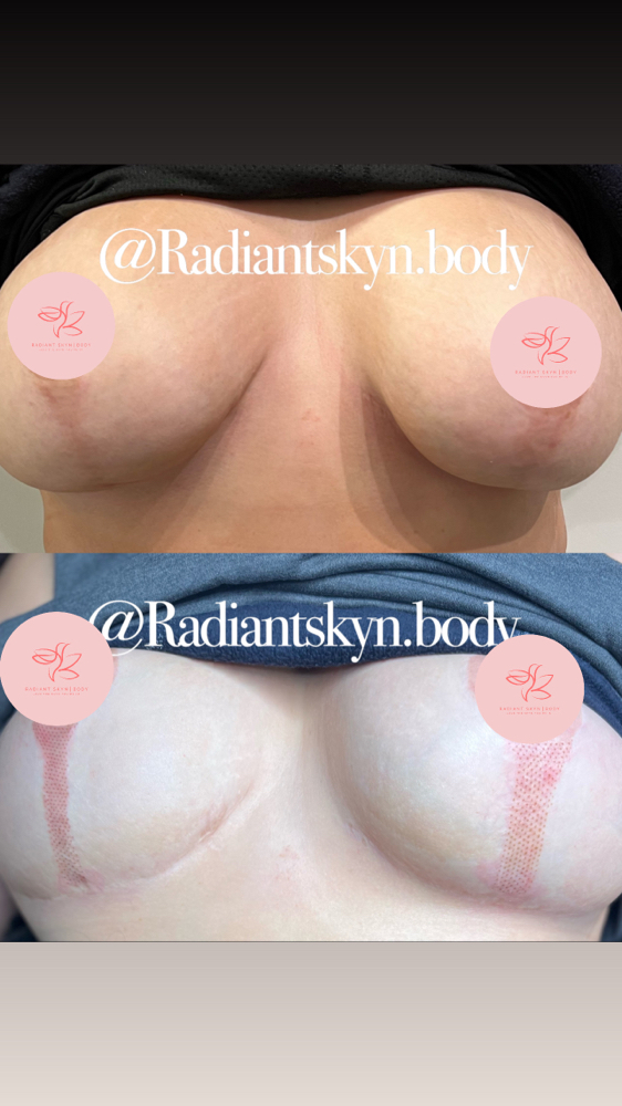 Breast Surgery Scar Lifting