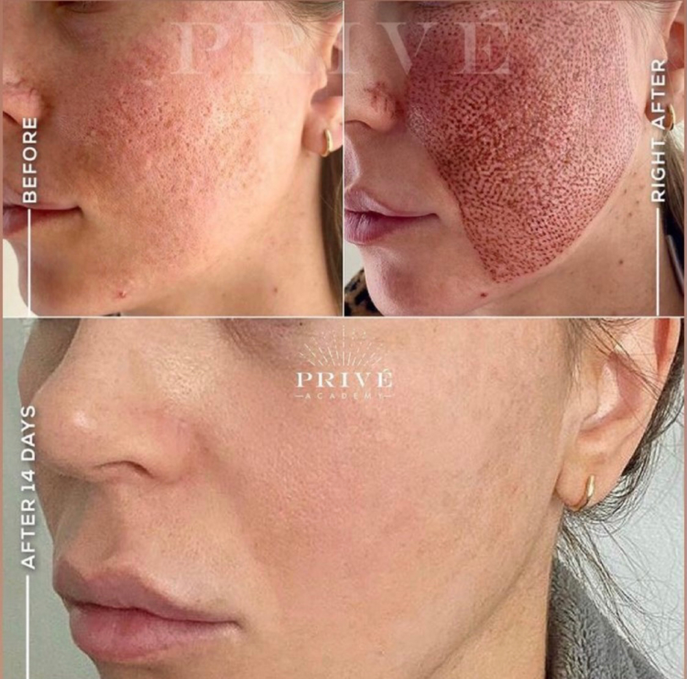Acne Scar Plasma Lift