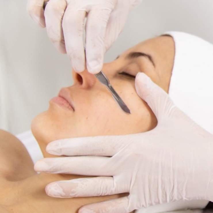 Dermaplaning