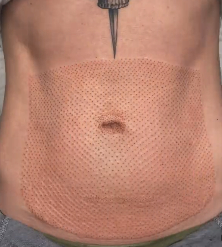 4x6 Area Abdomen Plasma Lift