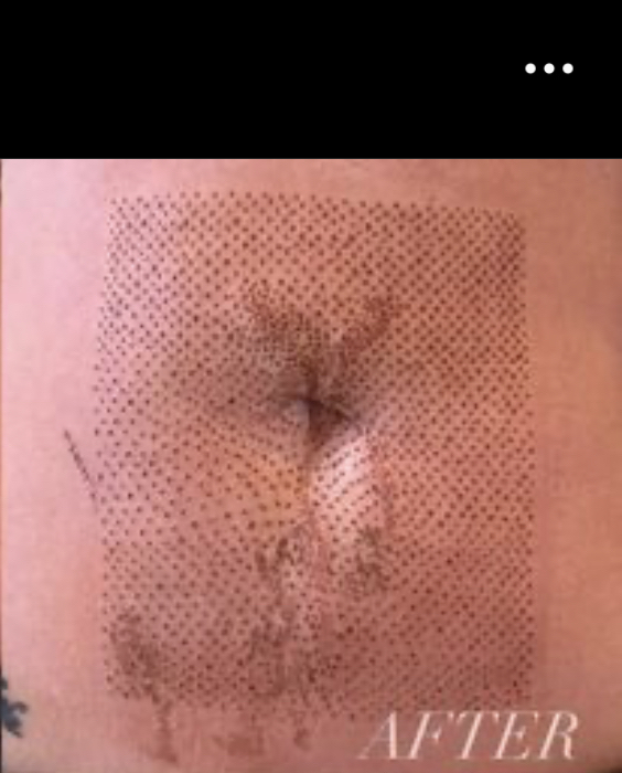 3x3 Area Abdomen Plasma Lift