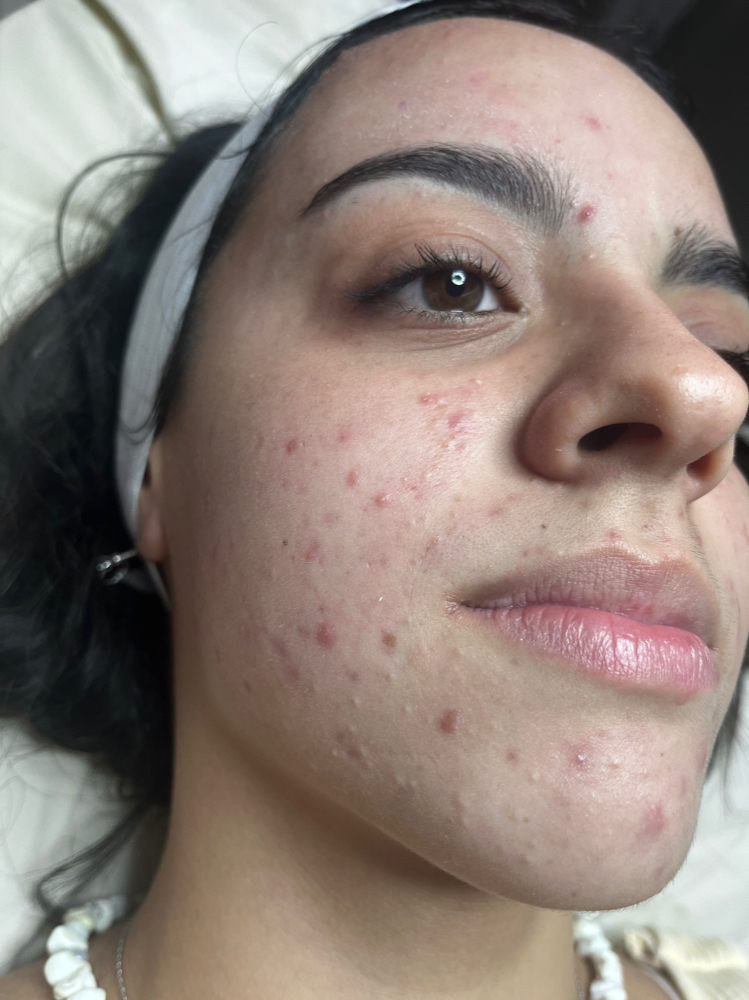 Micro Clarify at Acnessia Laser Clinic in Guaynabo, PR