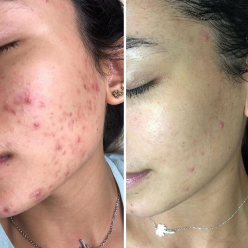 Micro Clarify at Acnessia Laser Clinic in Guaynabo, PR