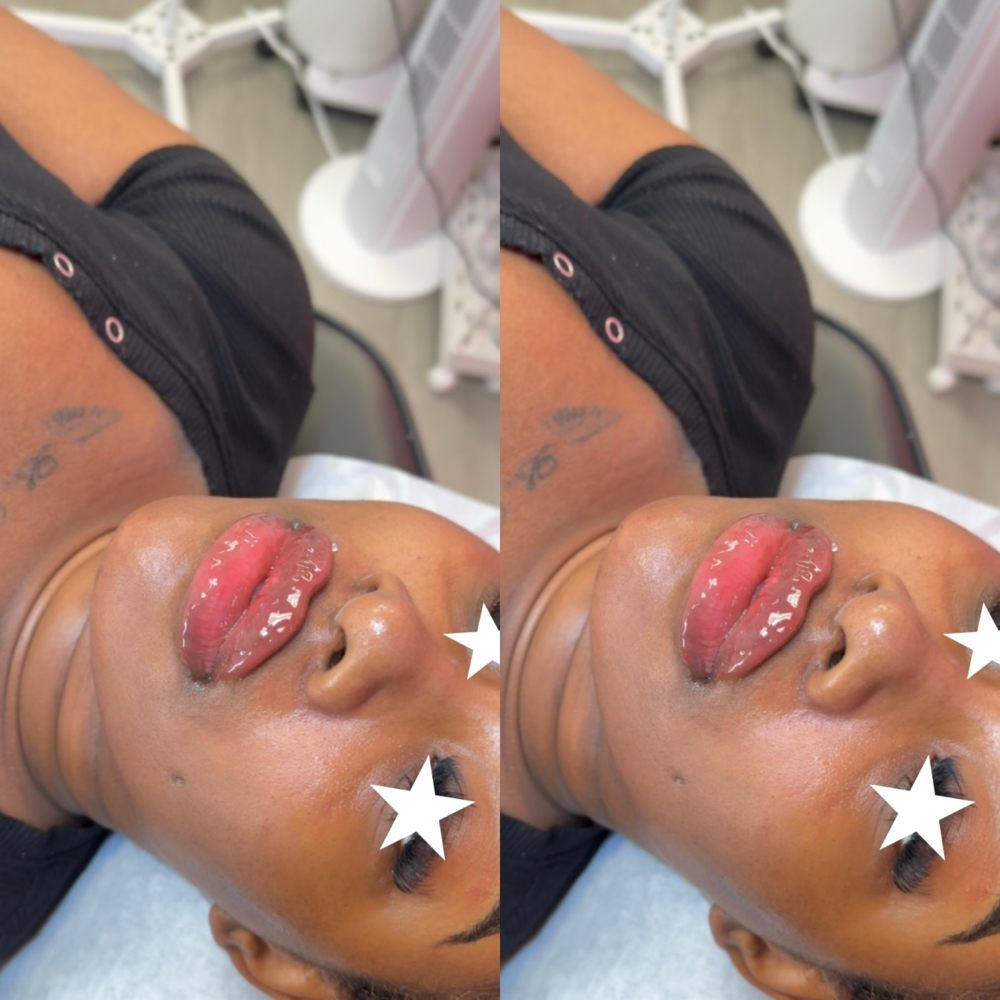 8ML | FACIAL BALANCING- SPECIAL
