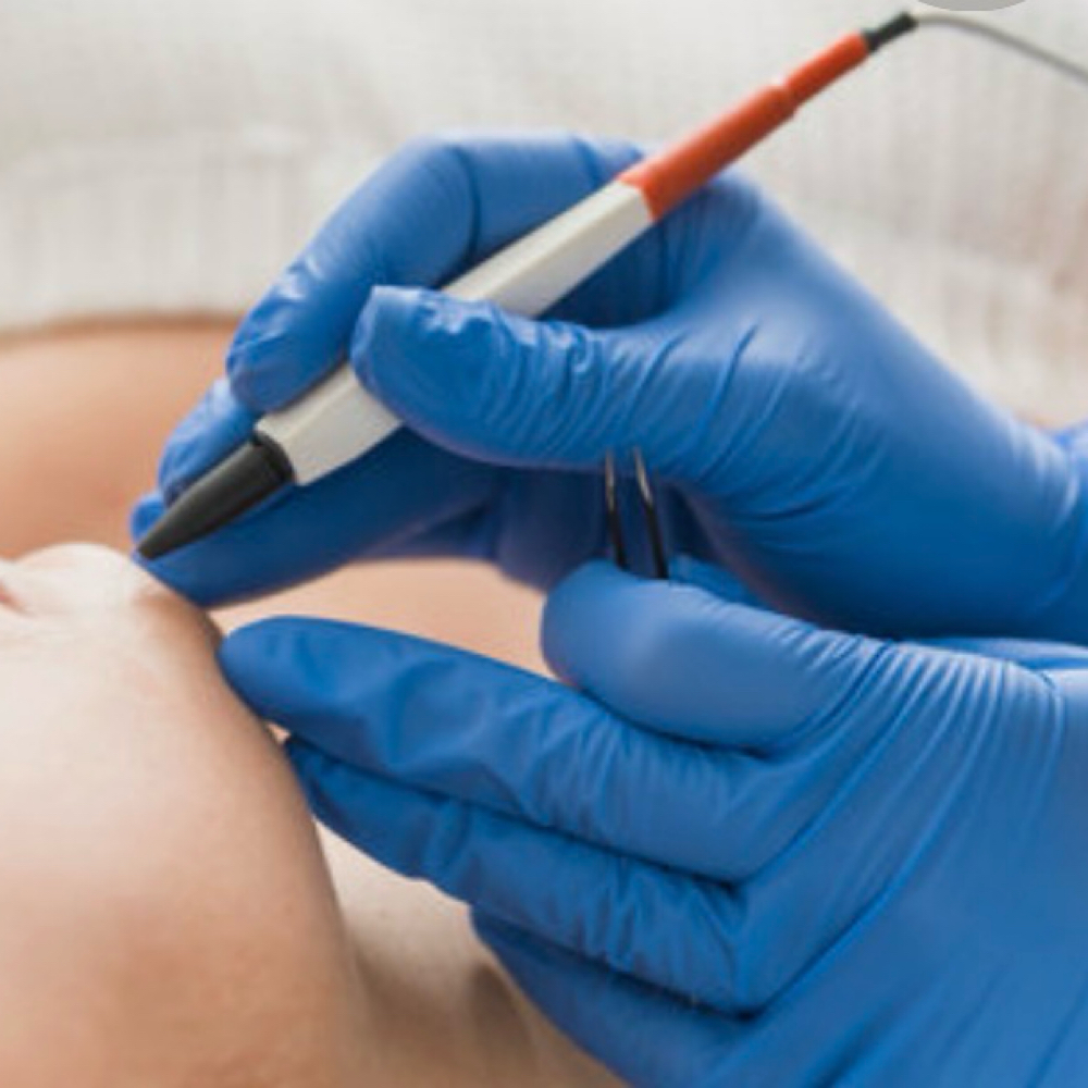 Electrolysis 15 mins at Skin Couture in Chicago, IL