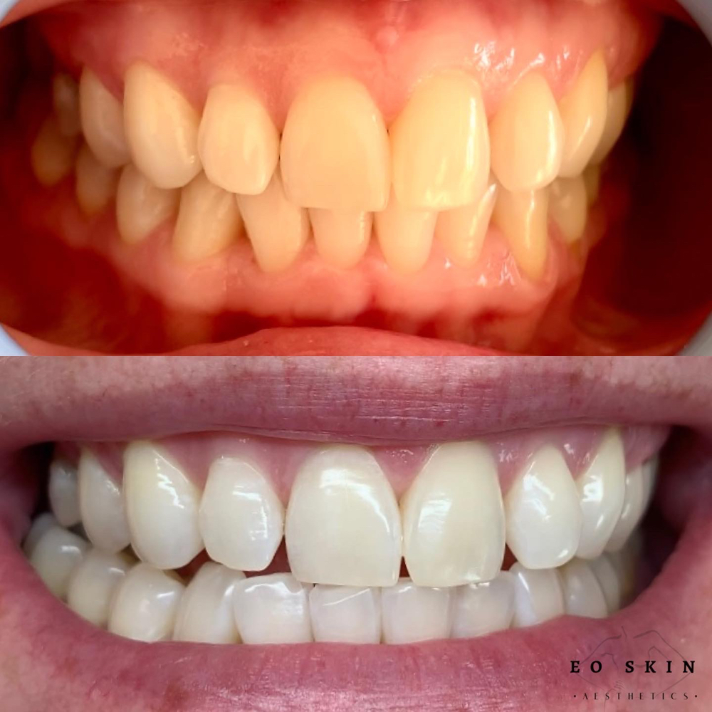 Laser Teeth Whitening