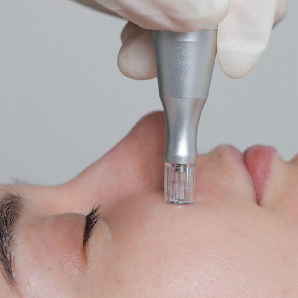 Nano Needle Facial at Bellas Beauty Esthetics in California, CA