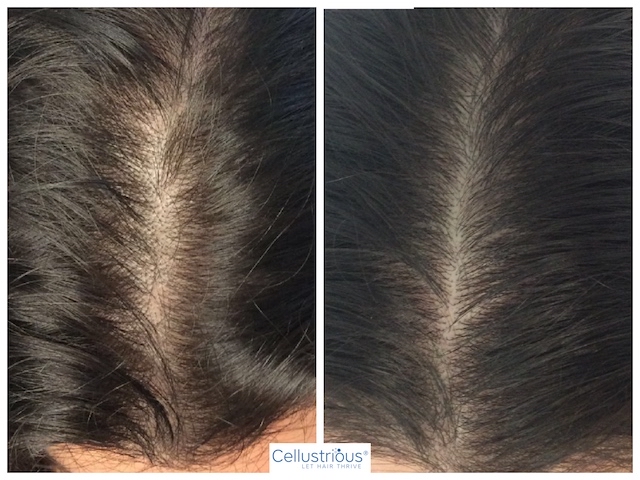 Hair Restoration Treatment