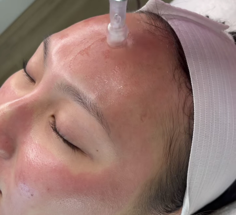 Microneedling Series Of 3