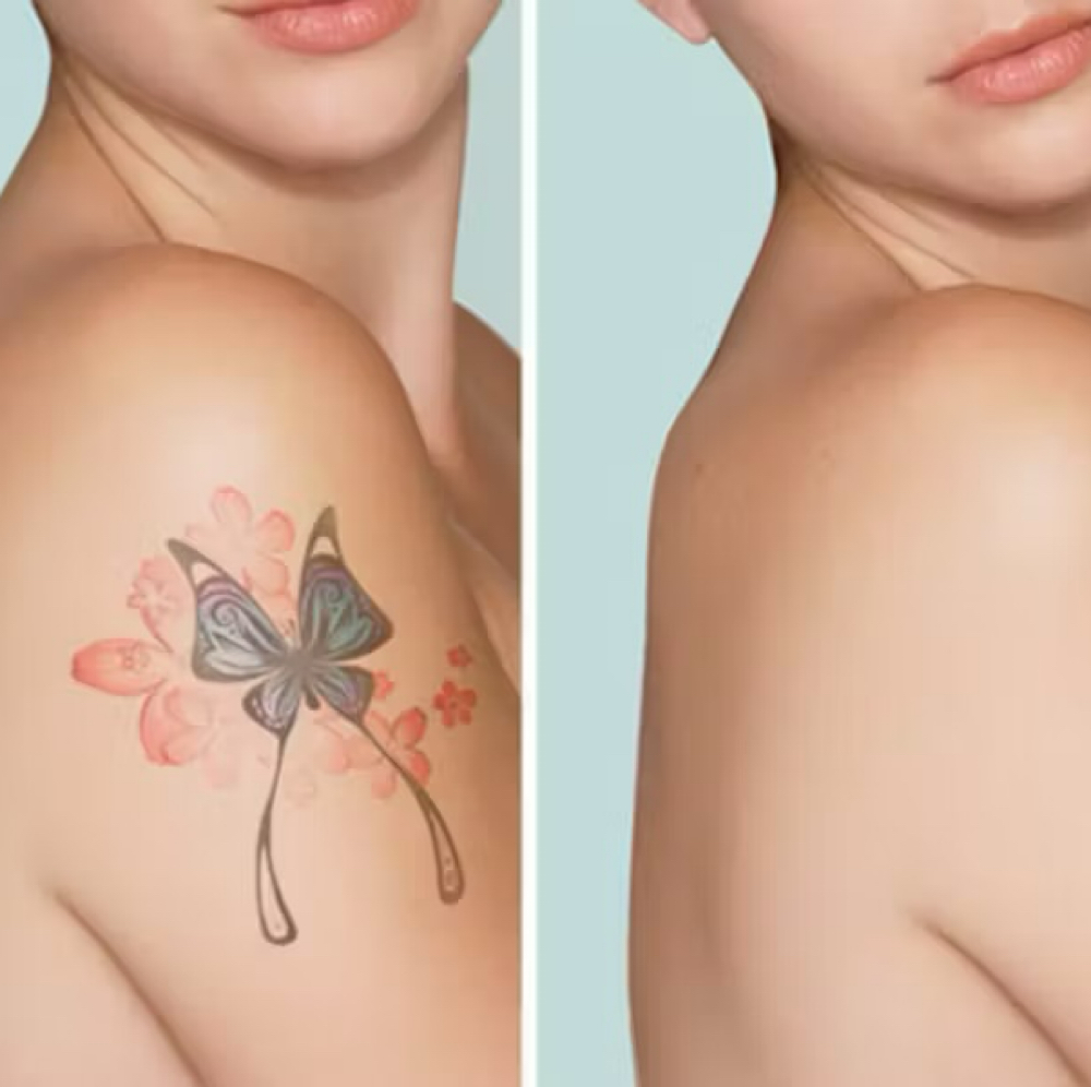 Laser Tattoo Removal at LUXOR BEAUTY BAR in ALPHARETTA, GA