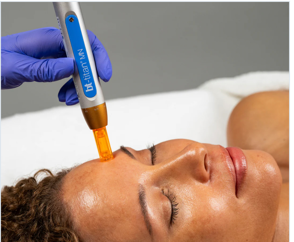 Microexfoliation: Nano Needling