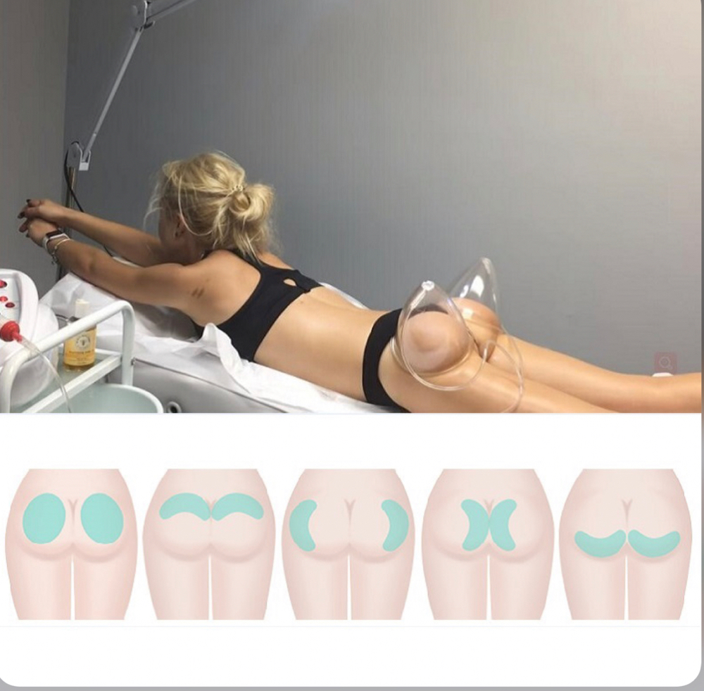 Buttocks Lifting / Firming