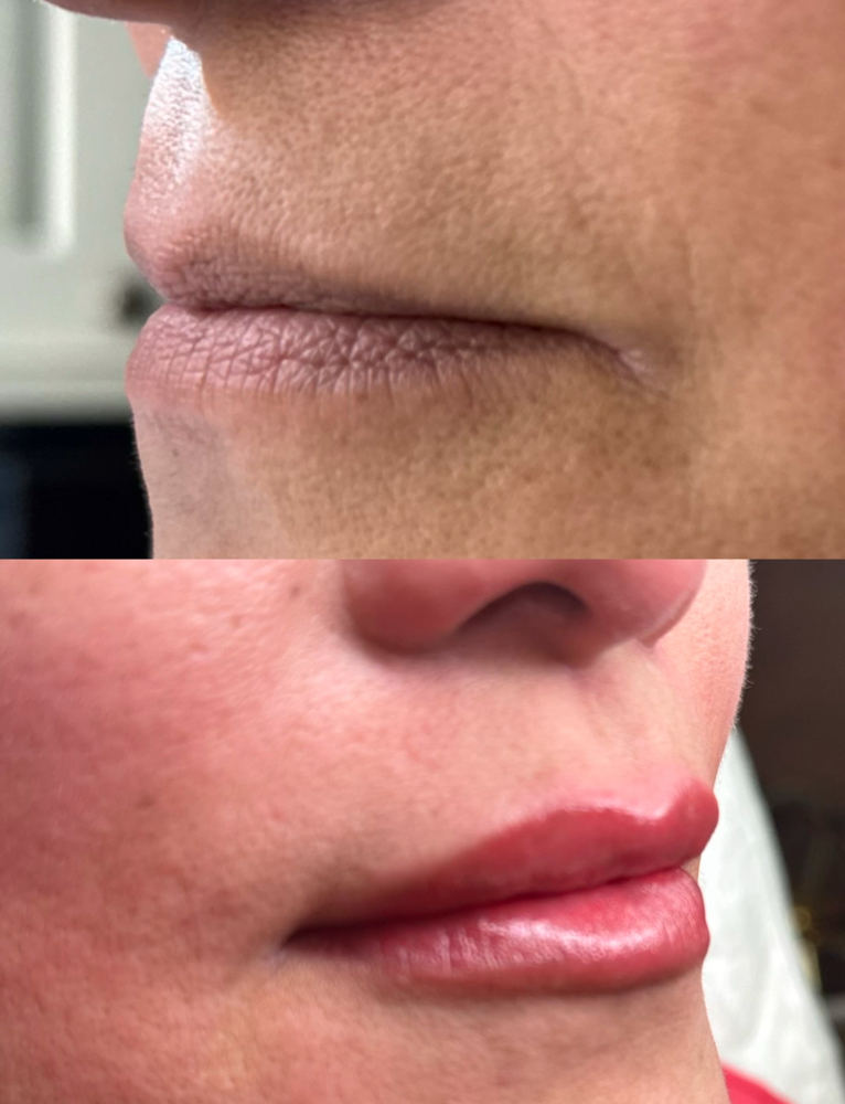 Lip micropigmentation