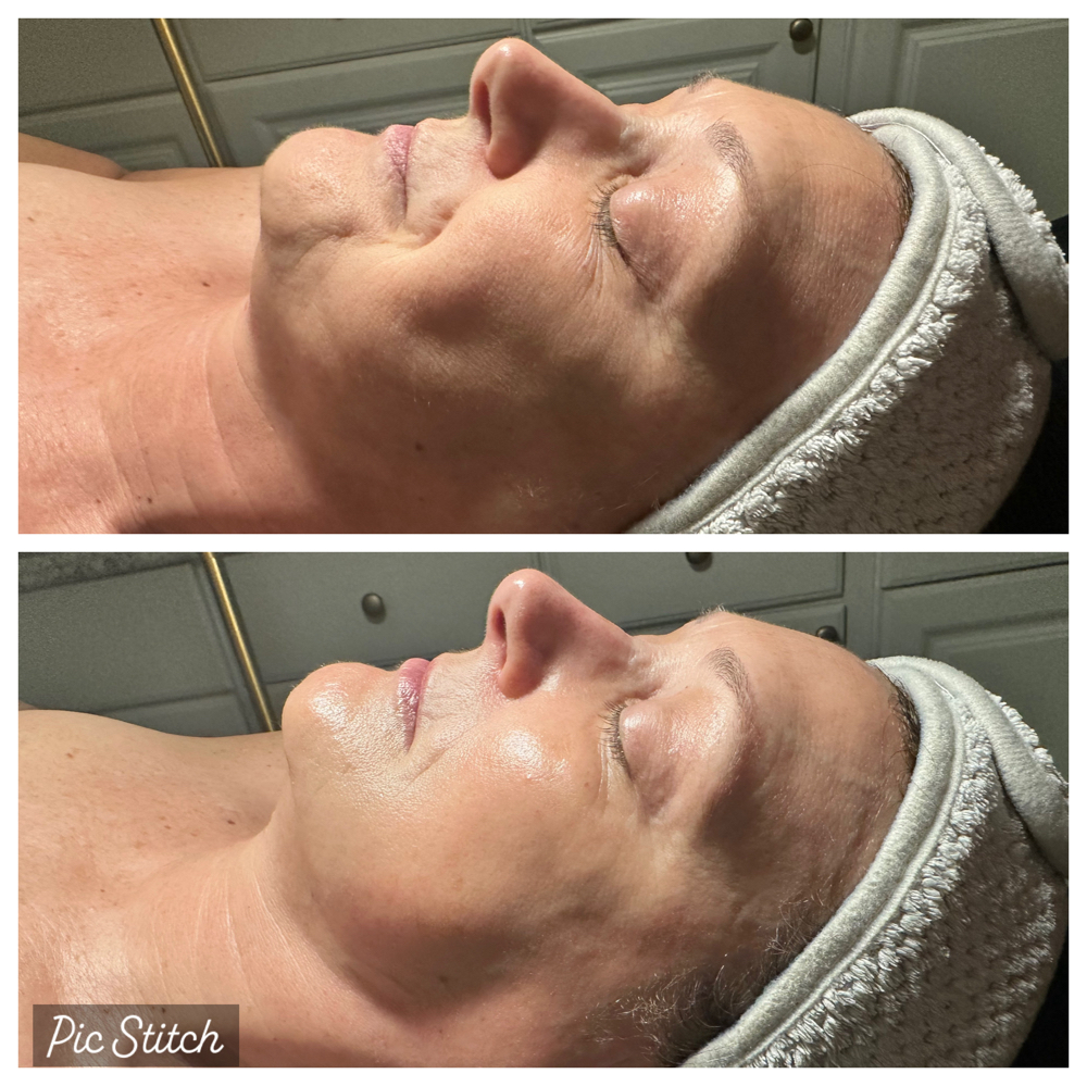 Dermaplane Facial
