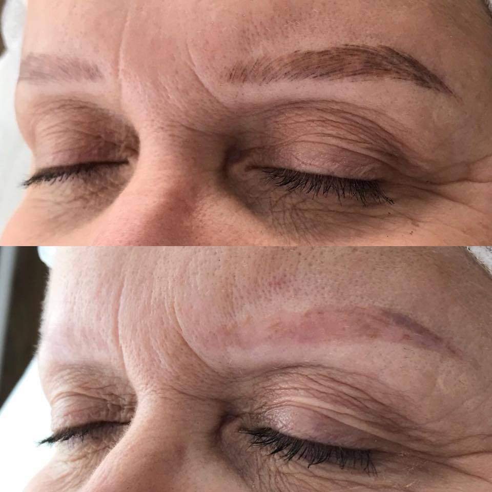 Permanent Brow Removal