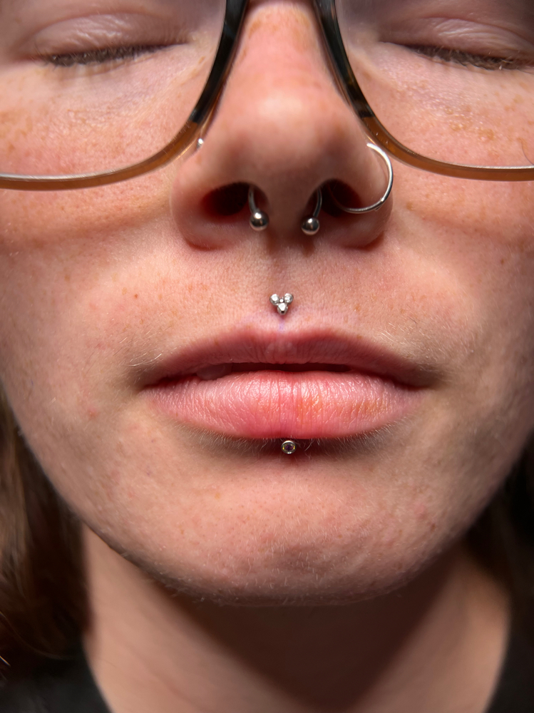 philtrum (medisa)